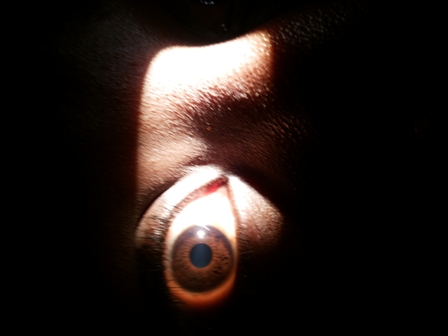 Atteinte oculaire dans l'algoataraxie Pr Aissatou Magatte WANE, Médecin ophtalmologiste professeur agrée en ophtalmologie à l'UFR